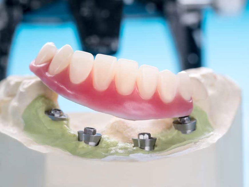 Types of Dental Implant Restorations featured image